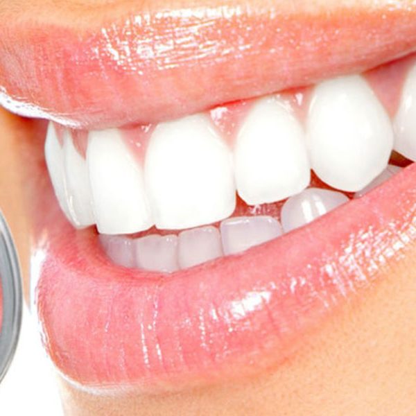 سفید کردن دندانها